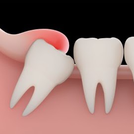wisdom tooth with best dentist in ranchi
