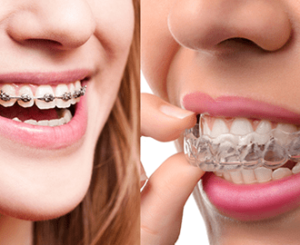 braces and aligners