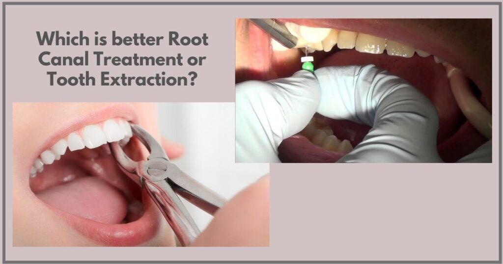 root canal vs dental extraction