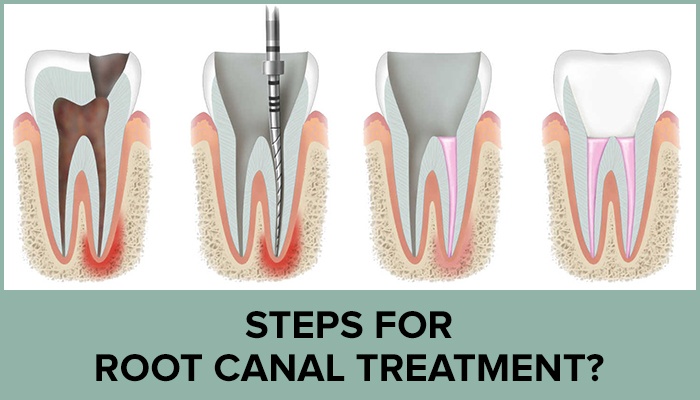 Root Canal Treatment