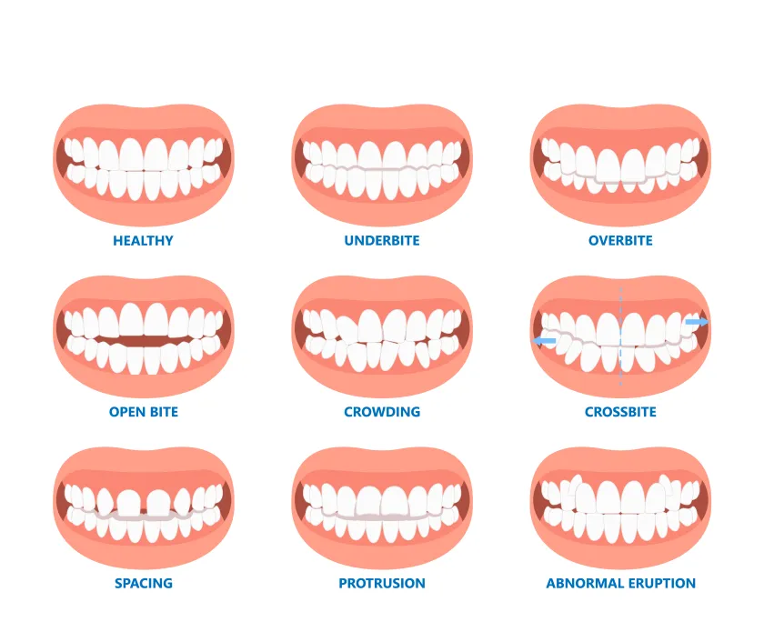 overbite vs underbite