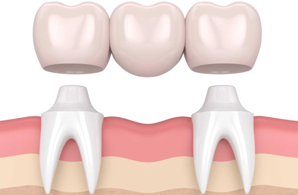 dental bridges