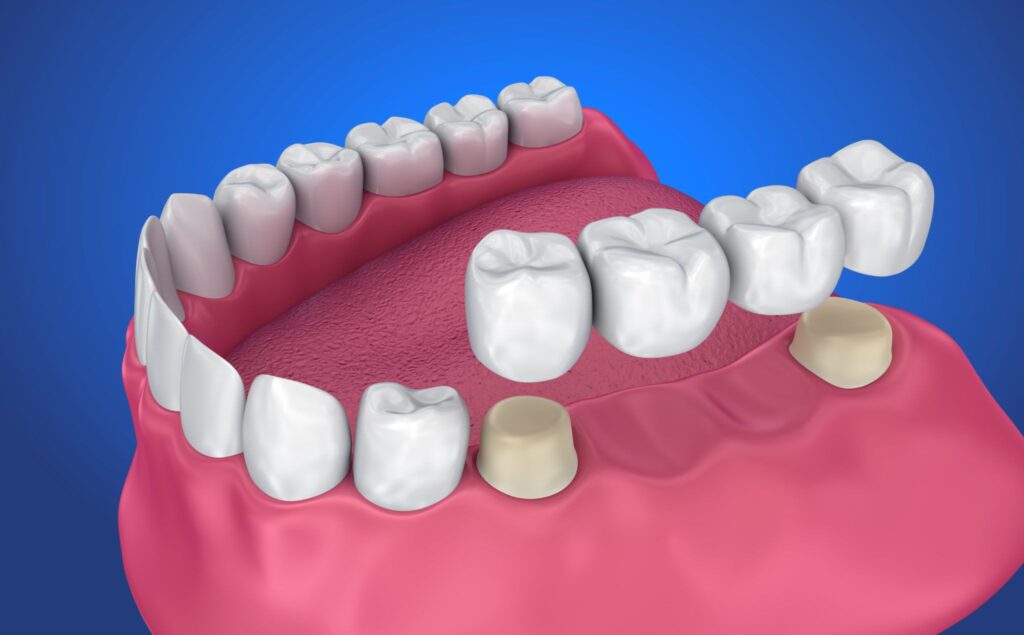 dental crowns and bridges