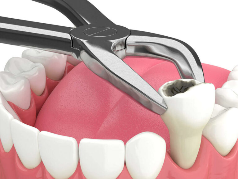 Tooth Extraction Service In Ranchi - Dr. Kaur's True Pearls Dental Care ...