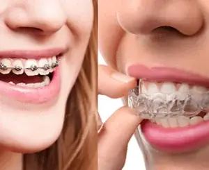 Braces and aligners