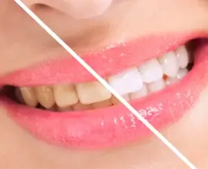 Teeth Whitening